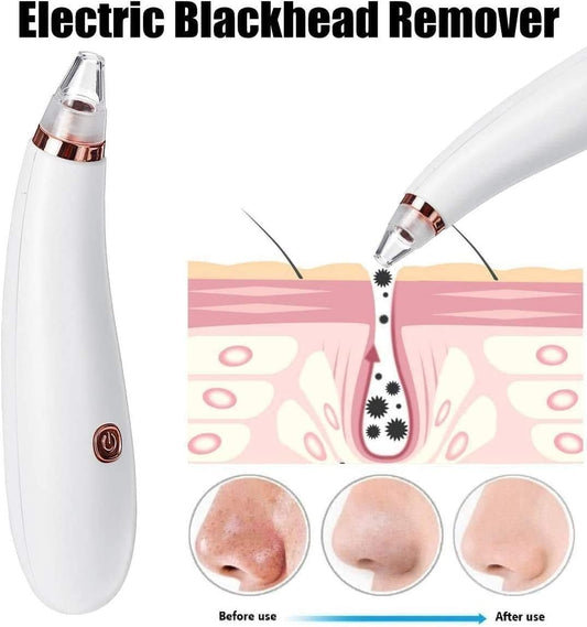 LIMPIADOR FACIAL REMOVEDOR DE PUNTOS NEGROS Y ESPINILLAS